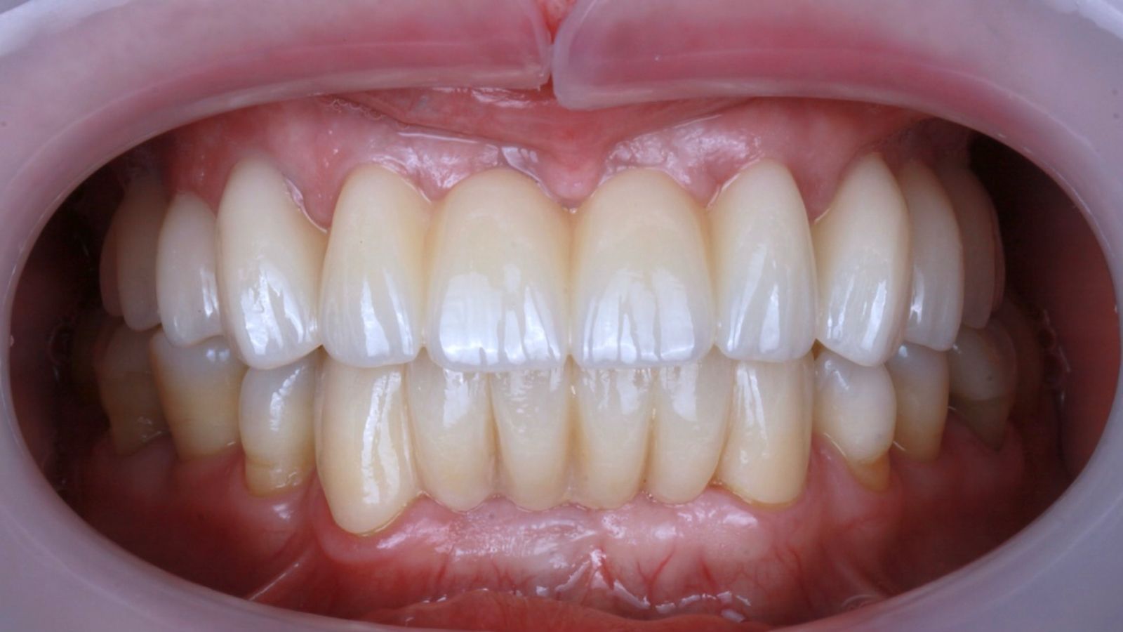 Failing upper teeth replaced, after treatment