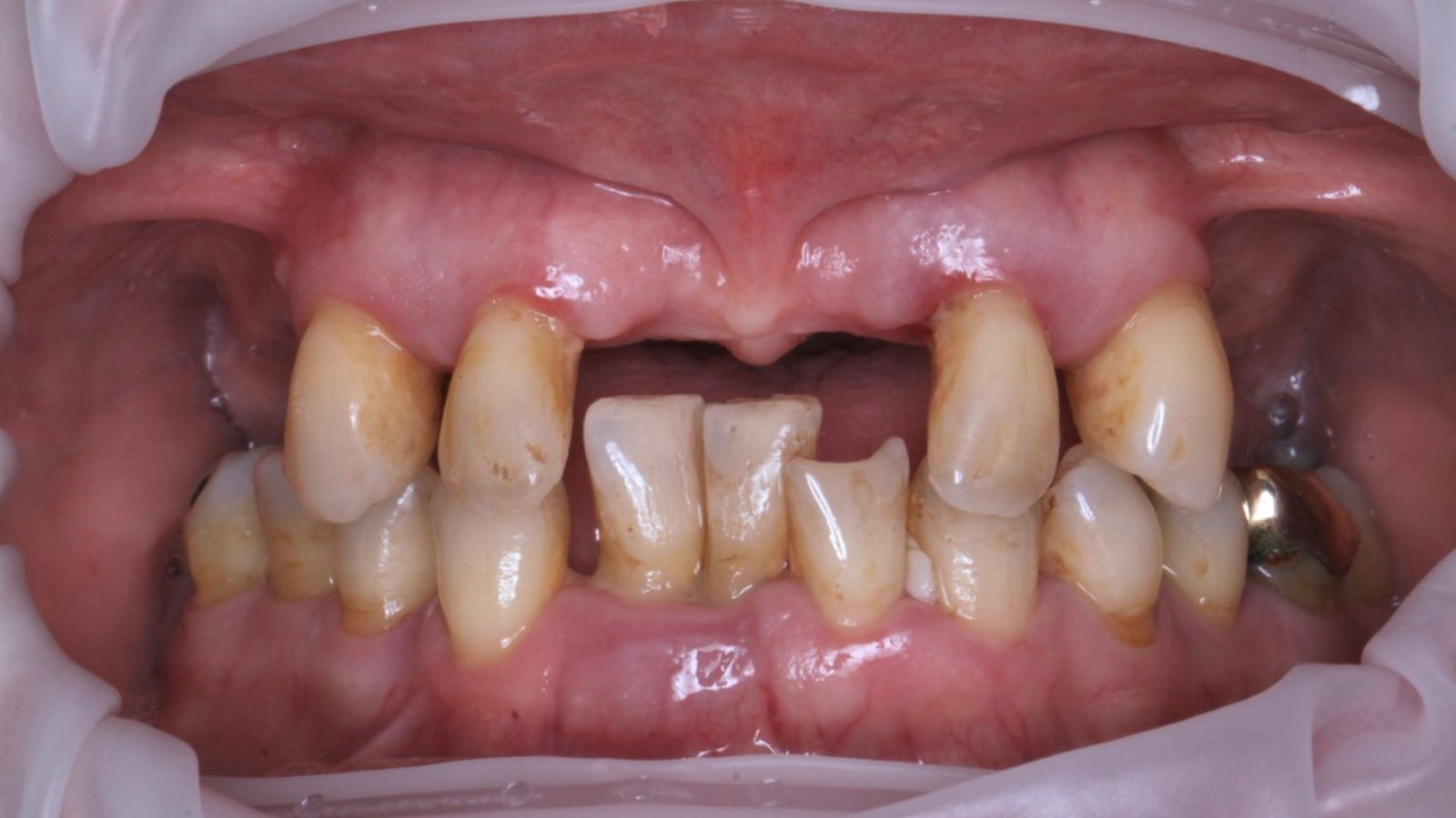 Failing upper teeth replaced, before treatment