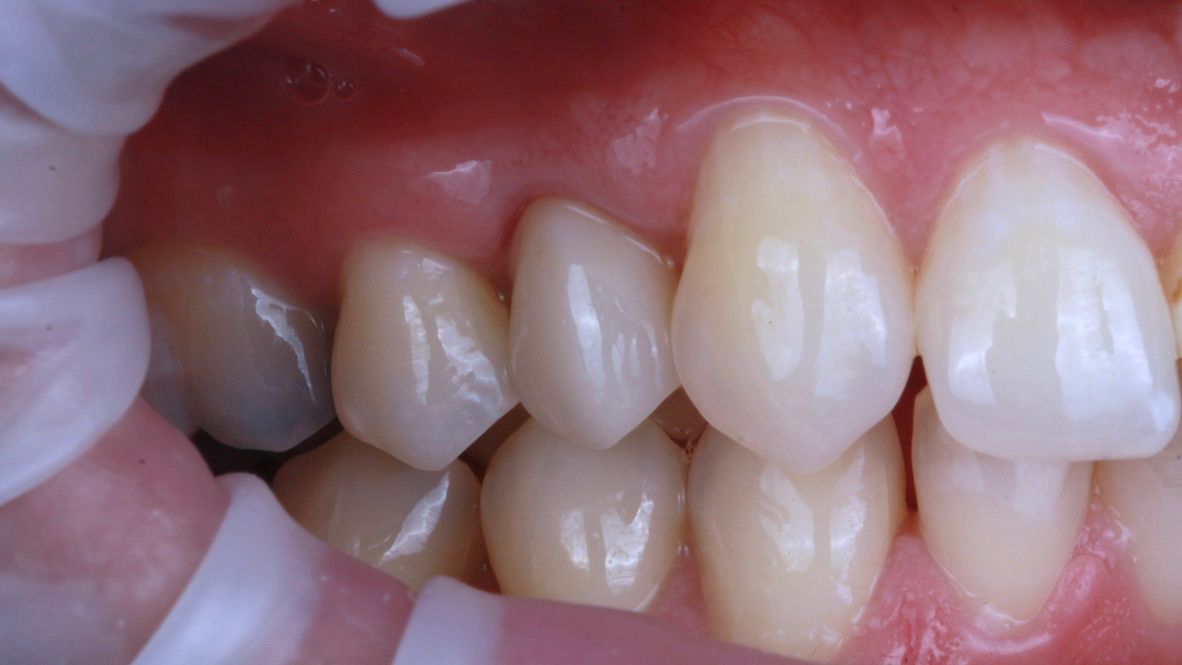 One broken back tooth rebuilt, after treatment