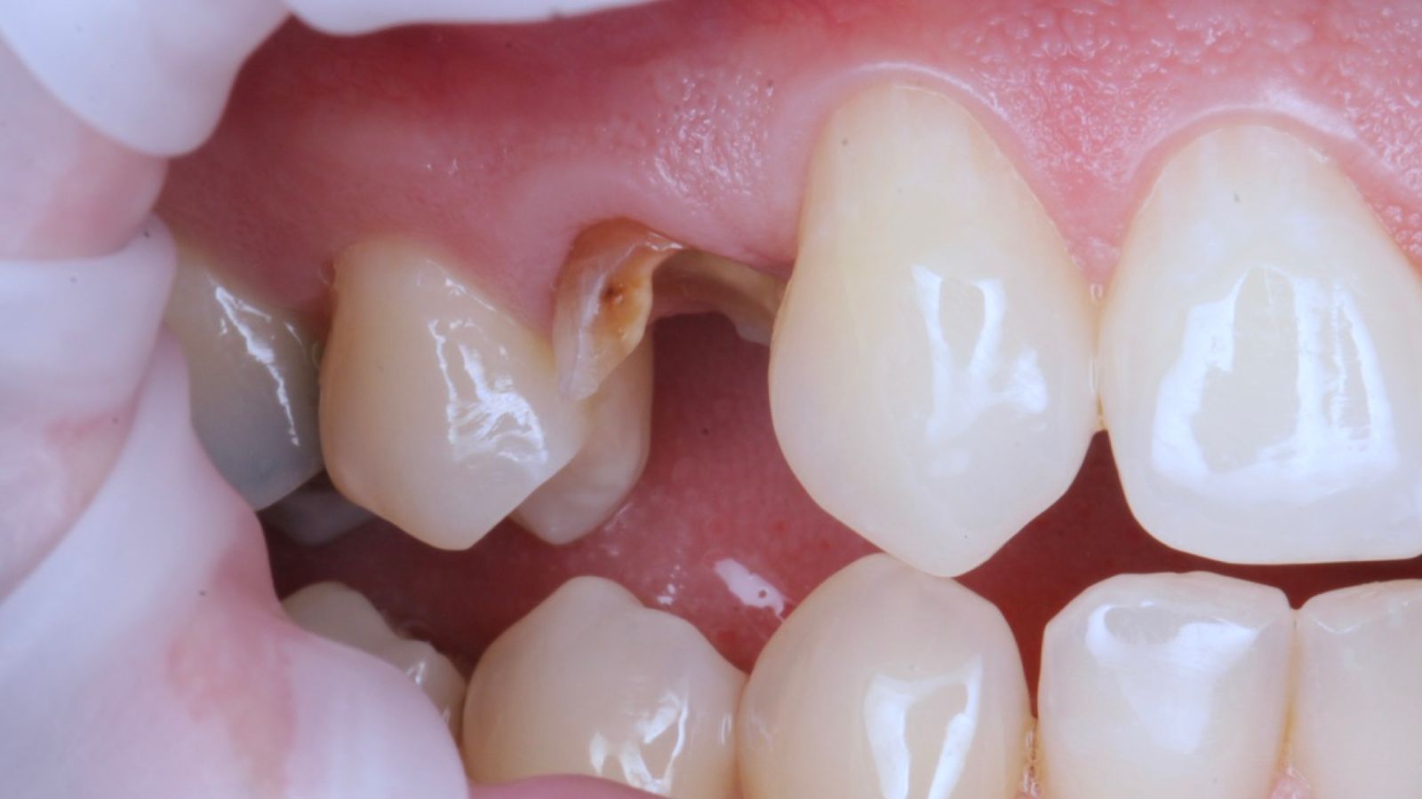 One broken back tooth rebuilt, before treatment