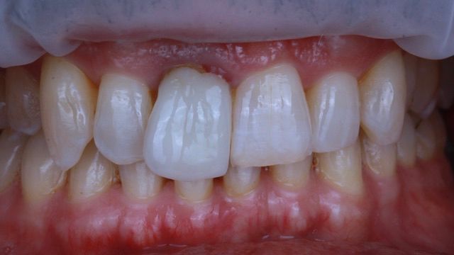 Front tooth matched to its neighbour, before treatment