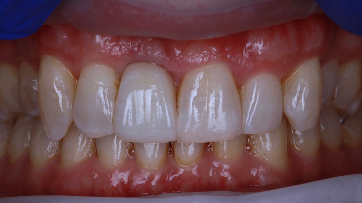 Front tooth matched to its neighbour, after treatment